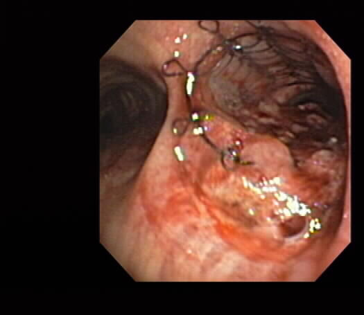 IIIafter destruction with APC balloon and stent