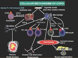 copd image 22